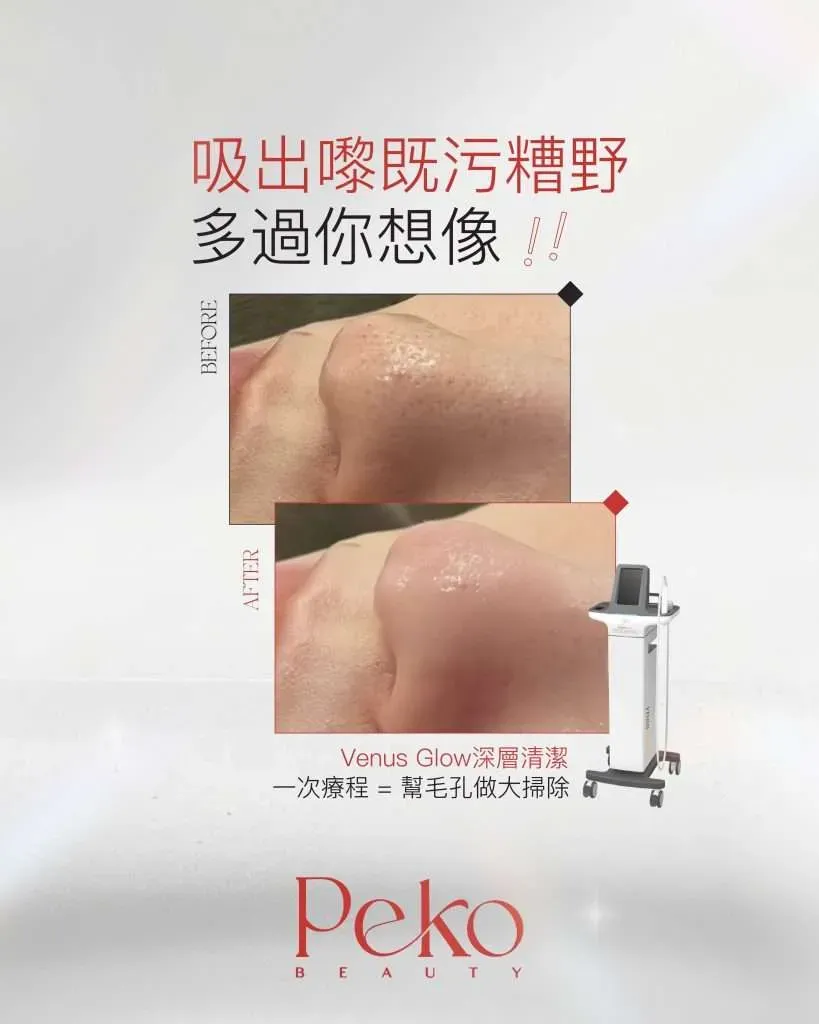 Peko Beauty 客人進行 Venus Glow 療程前後 VISIA 皮膚分析對比