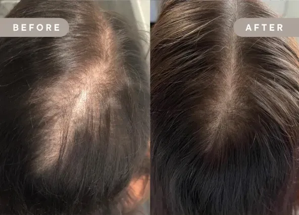 Sylfirm X 育髮分界線對比圖 (Before/After)